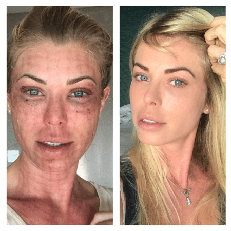 Caroline Bittencourt aparece com o rosto cheio de hematomas após procedimento - Reprodução/Instagram Caroline Bittencourt