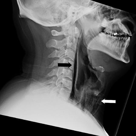 Setas indicam fratura na garganta de homem que segurou espirro - BMJ Case Reports