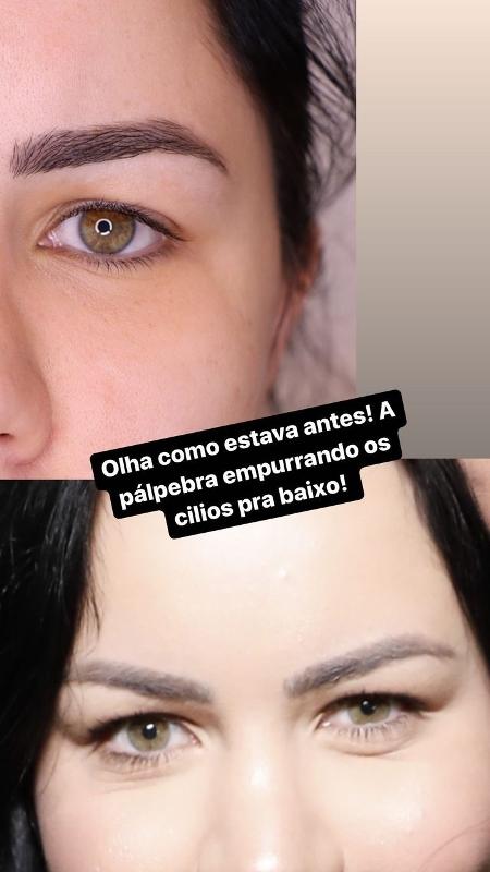 Bruna Tavares passa por cirurgia nas pálpebras; veja antes e depois