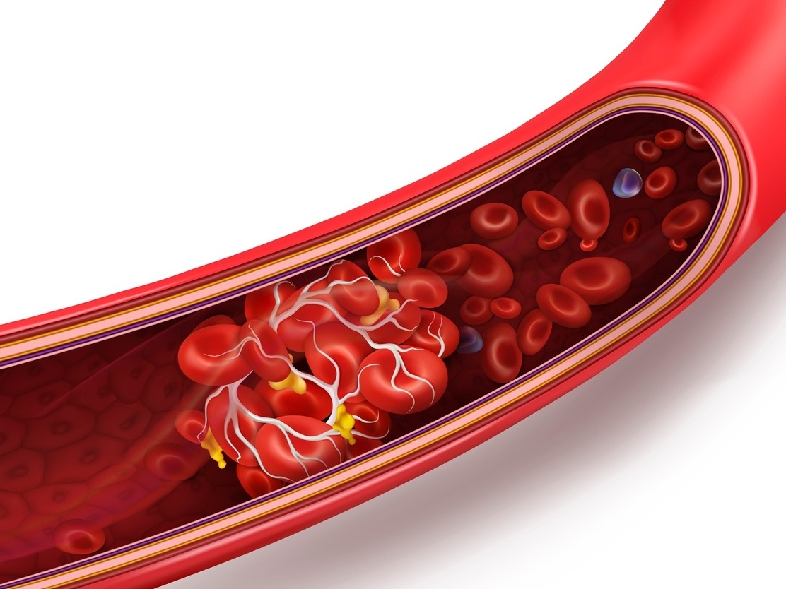 Fique atento aos sinais do infarto - Circular Cirurgia Vascular