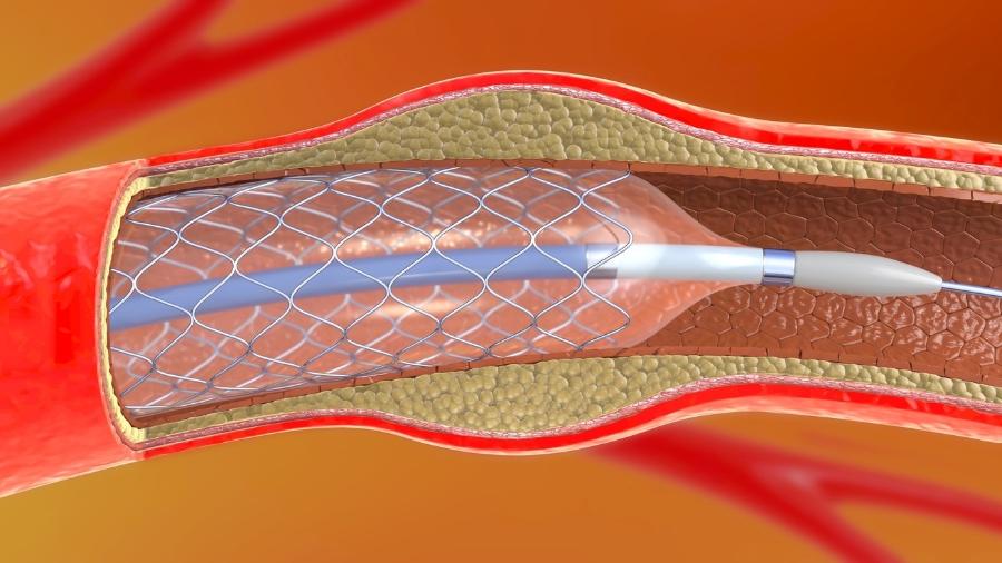 Na angioplastia, um stent (espécie de tubo metálico) é usado para "abrir" o vaso sanguíneo obstruído   - iStock