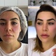 Naiara Azevedo harmonização facial - Divulgação