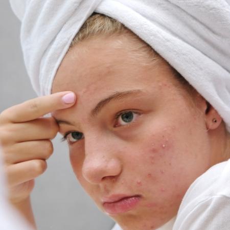 Estudo: pessoas com acne sofrem preconceitos na vida social e profissional Estudo: pessoas com acne sofrem preconceitos na vida social e profissional