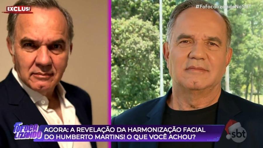 Humberto Martins antes (à esquerda) e depois da harmonização facial (à direita)