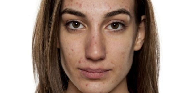 As causas da acne ainda são desconhecidas, mas há muitas especulações sobre - Thinkstock Images