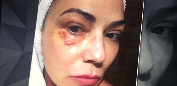 TV revela imagem de hematoma no rosto da modelo e atriz Luiza Brunet - Reprodução/TV Globo