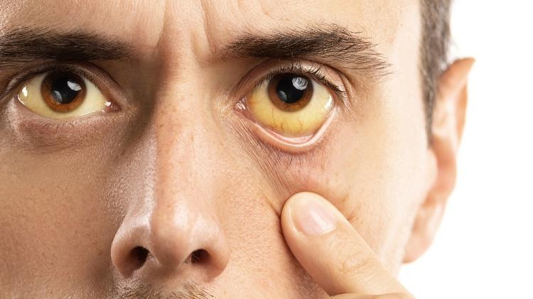 Olhos amarelados - iStock - iStock