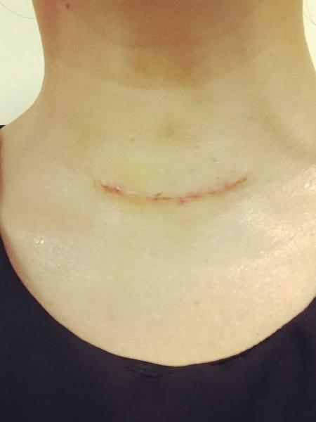 A cicatriz da cirurgia para a retirada da tireoide de Tânia Oliveira - Reprodução/Instagram - Reprodução/Instagram
