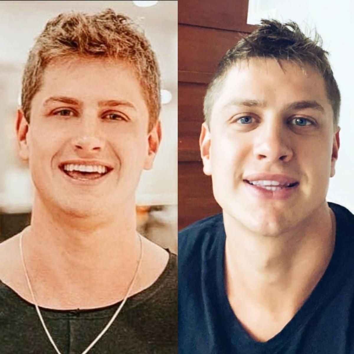 O ex-BBB Lucas Gallina, antes e depois de harmonização facial - Reprodução/Instagram