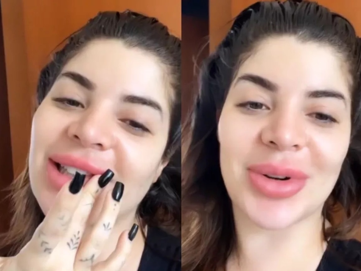 Labios Inchado Reacao Alergica Nos Labios