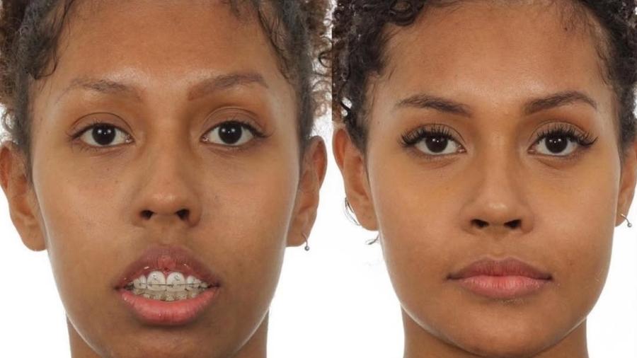 Antes e depois dois meses após a cirurgia divulgado pela cirurgiã bucomaxilofacial de Giovanna Jacobina, participante do BBB 25 - Reprodução/Instagram/@drakatyuscia