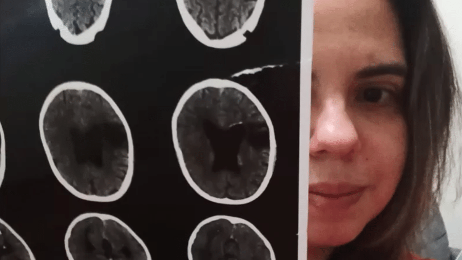 Camila Fabro demorou dois anos para ser diagnosticada corretamente com agnosia e prosopagnosia adquirida - Arquivo pessoal via BBC News Brasil