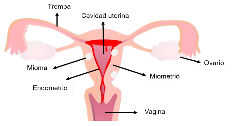 Ilustração da estrutura de um útero humano com três miomas e na fase de menstruação, com descolamento do endométrio