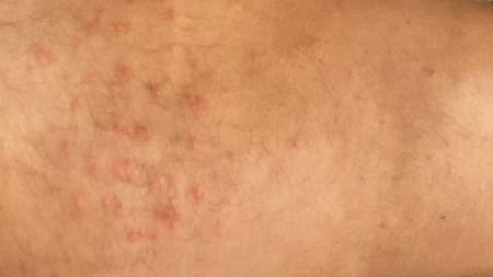8 Causas de manchas vermelhas na pele que coçam