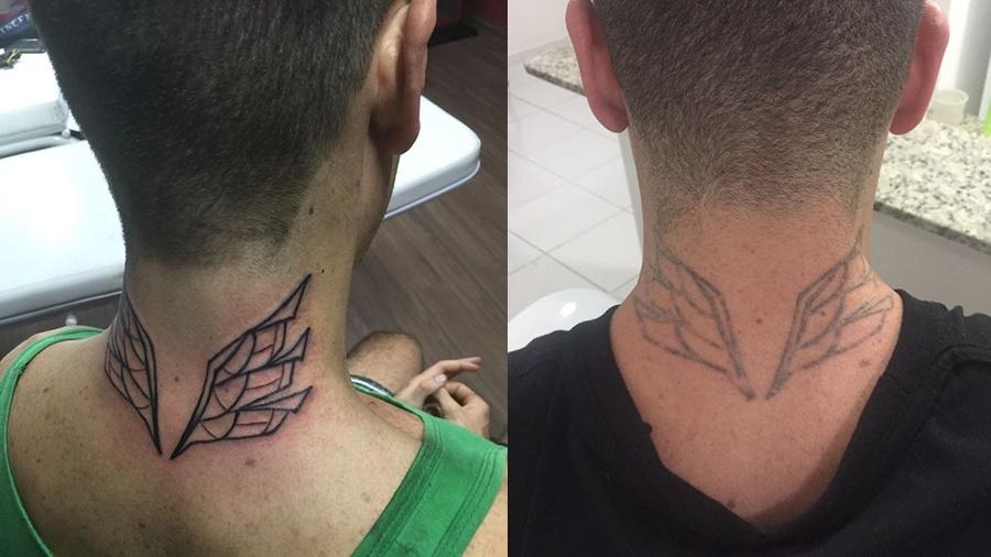 O DJ Breno Coutinho se arrependeu da tatuagem; à direita, resultado após 4 sessões de laser - Arquivo Pessoal