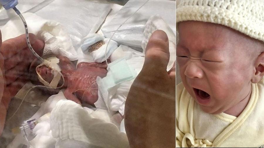 Menor bebê do mundo quando nasceu e em 20 de fevereiro, seis meses depois - Cortesia de Keio University Hospital/Kyodo News