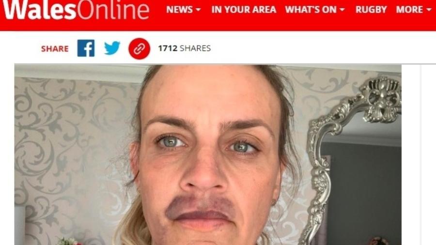 Kelly Rogers, de 40, realizou preenchimento labial que a deixou com hematomas no rosto - Reprodução/WalesOnline