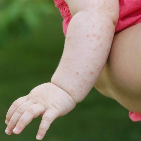 O sarampo pode gerar complicações graves especialmente em crianças - Getty Images