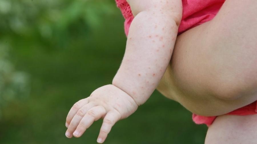 Segundo o Ministério da Saúde, a vacinação é preventiva e deve alcançar 1,4 milhão de crianças, que não receberam a dose extra - Getty Images