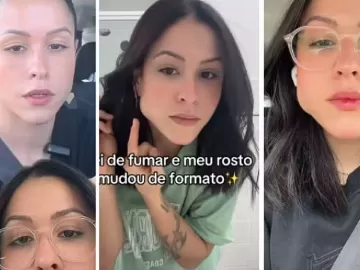 Influencer tem mandíbula quadrada por causa de chiclete; o que é a condição