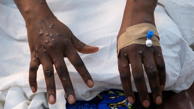 Erupções cutâneas causadas pelo vírus mpox Erupções cutâneas causadas pelo vírus mpox