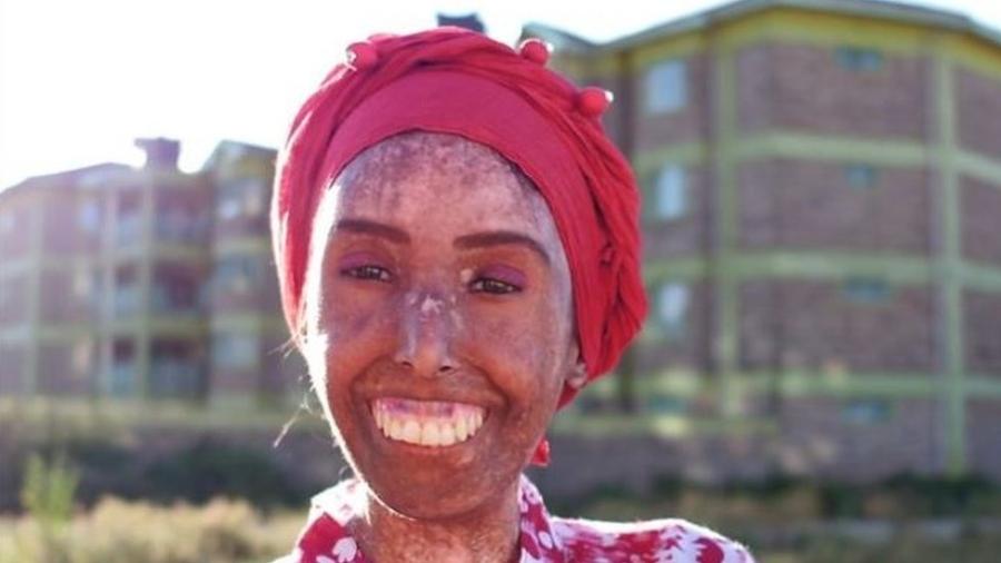 Farah Khaleck sofre de esclerodermia, uma doença que enrijece a pele - BBC