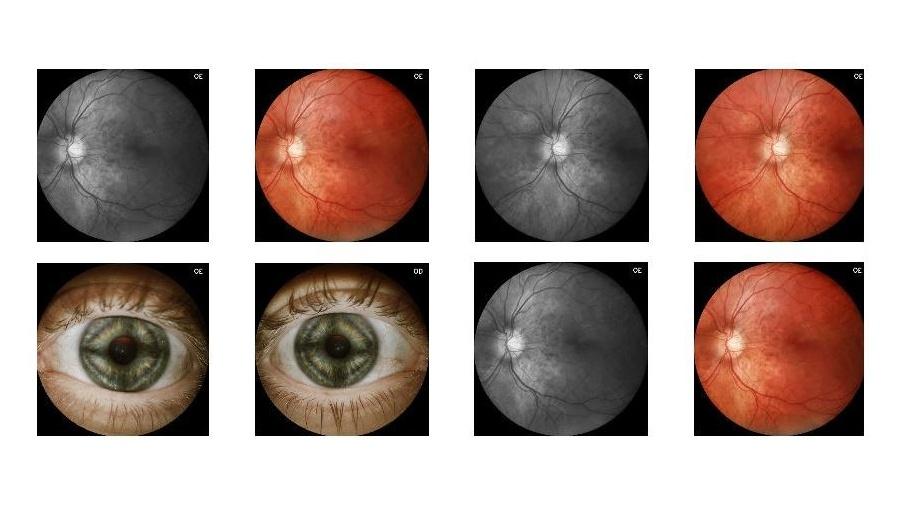 Empresa de São Carlos criou o Eyer, dispositivo acoplado a um smartphone que examina a retina e detecta retinopatias a um custo mais baixo do que os métodos convencionais - Divulgação