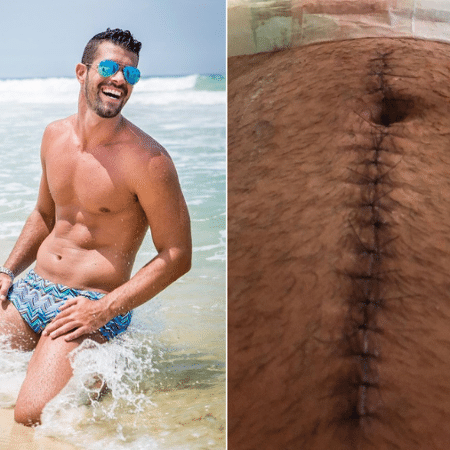 Bruno Miranda exibe cicatriz após ser baleado - Reprodução/Instagram
