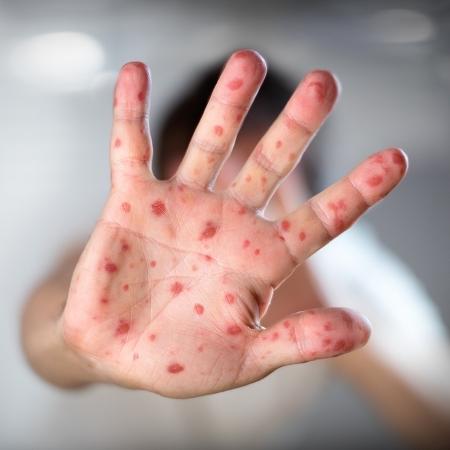 Manchas vermelhas pelo corpo, tosse, febre e coriza são sintomas de sarampo - RomoloTavani/iStock