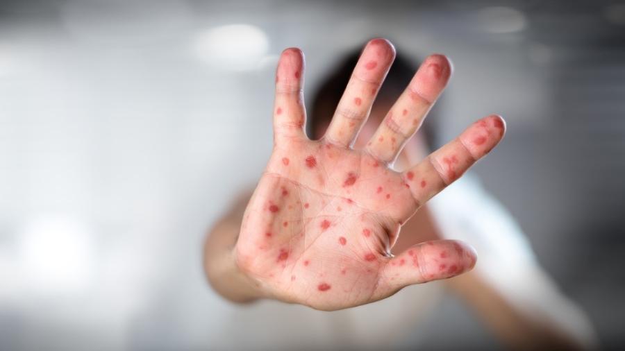 Segundo dados do Ministério da Saúde, o Brasil tem, atualmente 337 casos de sarampo registrados e confirmados - RomoloTavani/iStock