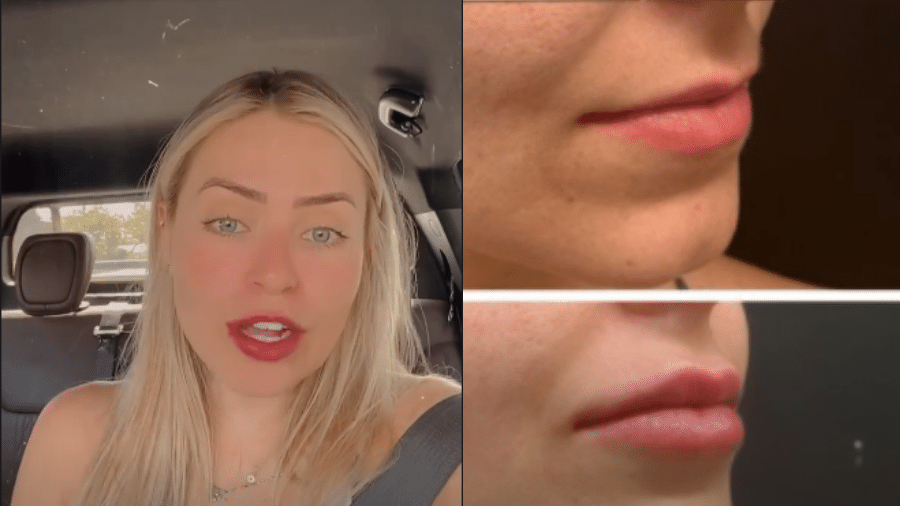 Paula Sperling mostra antes e depois da boca - Reprodução/Instagram