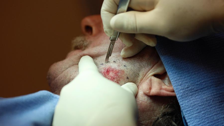 Um médico remove células da pele possivelmente cancerígenas - Luke Sharrett/The New York Times