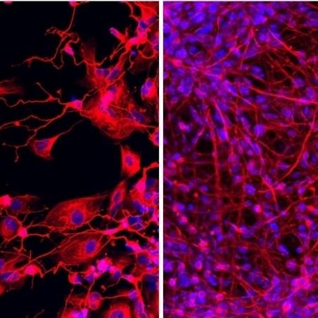 Por meio de reprogramação celular, pesquisadores da USP descobriram que mutação genética está associada a formação anormal e morte prematura de neurônios. Na imagem da esquerda é possível observar neurônios derivados de células de um paciente com deficiência intelectual. À direita, neurônios derivados de células de um parente não afetado - halita Figueiredo/CEGH-CEL