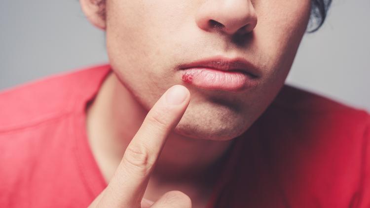 Herpes labial também pode provocar herpes genital. Herpes labial também pode provocar herpes genital.