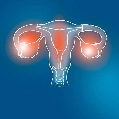 A endometriose é caracterizada pela presença de tecido endometrial (conteúdo da menstruação) fora da camada interna do útero - iStock