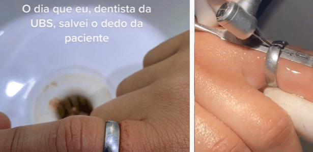 Dentista tira anel preso em dedo de paciente com instrumento inusitado