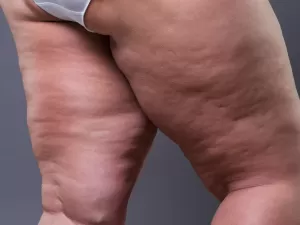 Como identificar e tratar lipedema, doença confundida com obesidade