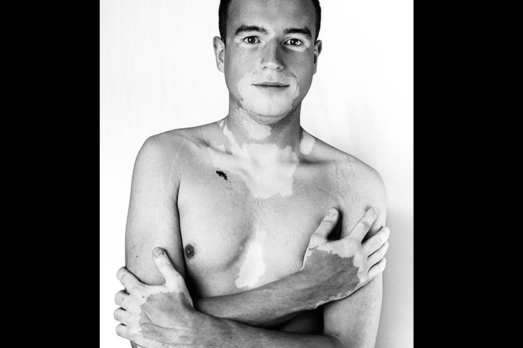 Modelos com vitiligo - Divulgação/Julia Kaczorowska