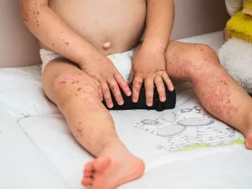 Doença mão-pé-boca é muito contagiosa: entenda causas e seus sintomas