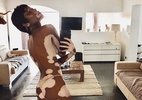 Top com vitiligo posta nude e dá recado: "celebre sua beleza única" - Reprodução/Instagram