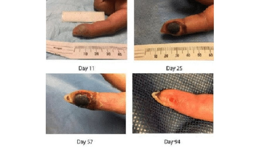 Acima, imagens da ferida da paciente nos dias e meses após o acidente. A cicatrização ocorreu apenas quatro meses depois - Reprodução/CDC