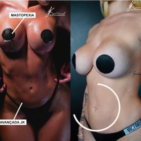 Karoline Lima surpreende com antes e depois de procedimentos estéticos