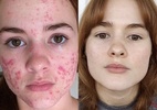 Jovem usa redes sociais para mostrar difícil jornada contra a acne - Reprodução/Instagram