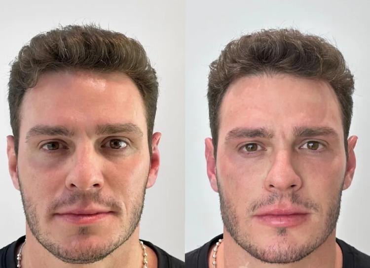Antes e depois da harmonização facial de Gustavo Benedeti - Reprodução/Instagram - Reprodução/Instagram