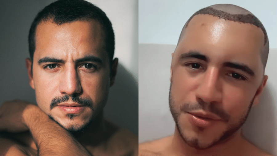 O ex-BBB Matheus Lisboa surgiu com a cabeça inchada após realizar um transplante capilar - Reprodução/Instagram