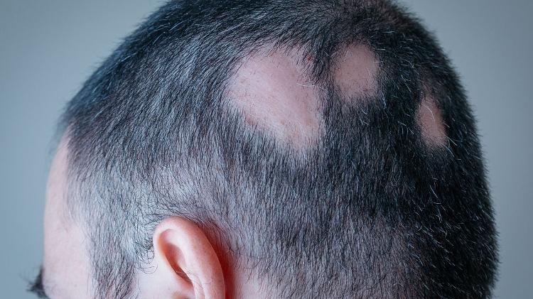 alopecia aerata, calvície, estresse - iStock - iStock