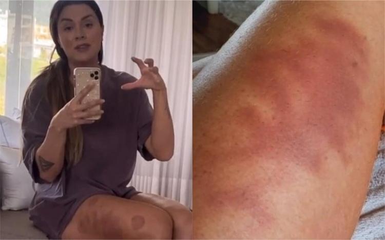 Juju Salimeni faz tratamento com ventosa - Reprodução/Instagram - Reprodução/Instagram
