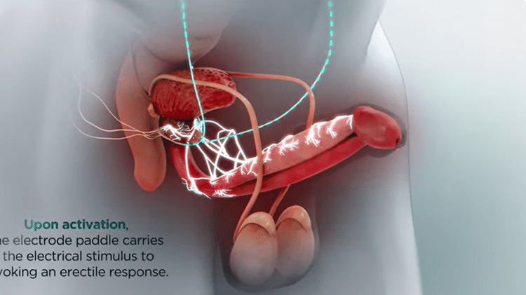 Esquema mostra funcionamento do dispositivo na genitália masculina