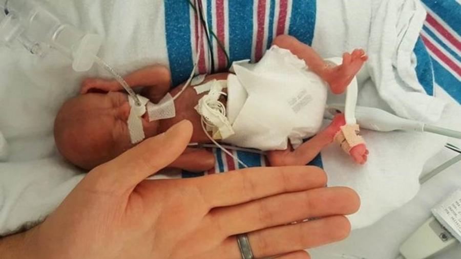 Connor em julho de 2018, poucos dias após nascer, ao lado da mão do pai, John Florio - Jamie and John Florio