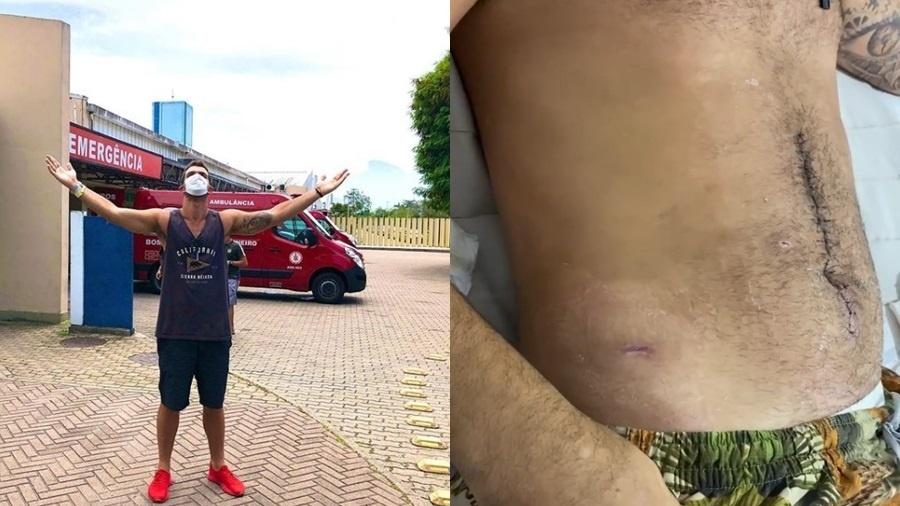 Bruno Miranda, o Borat de "Amor & Sexo", mostrou cicatrizes da cirurgia - Reprodução/Instagram